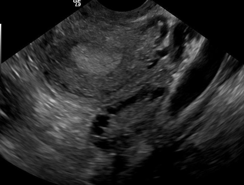 Intrauterine Insemination (IUI)