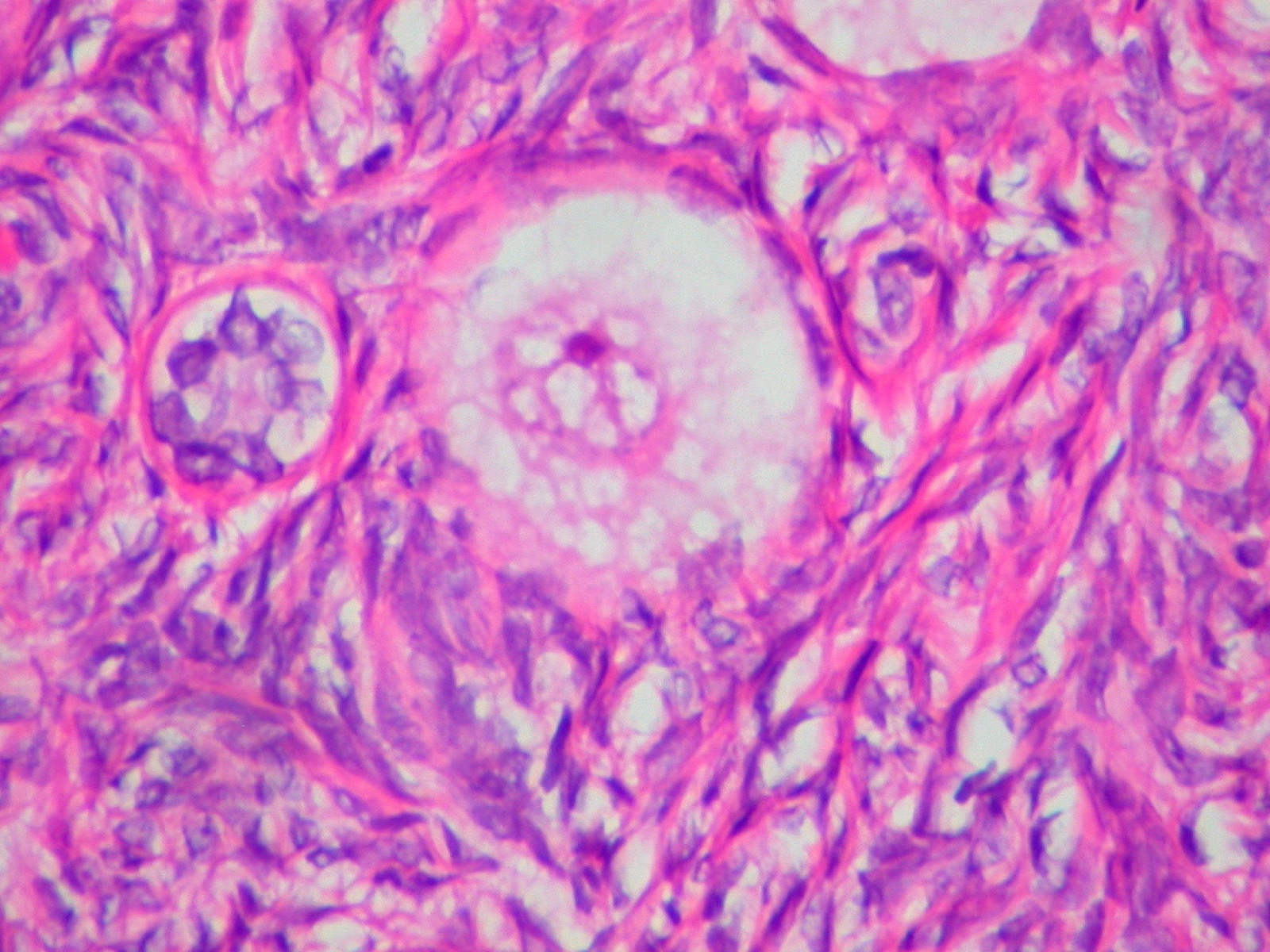 PICSI — Physiological ICSI